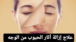 علاج إزالة أثار الحبوب والبقع السوداء في الوجه وتبييض البشرة في الاعشاب (المعالج ابوعمر)
