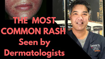 What can I put on perioral dermatitis?