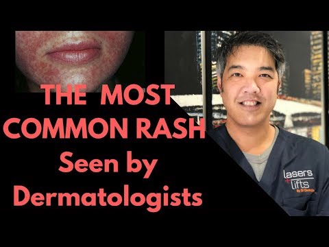 Video: Oral Rose - Perioral Dermatitis