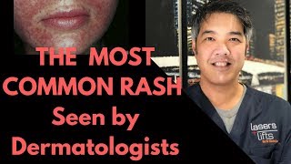 How to treat Perioral Dermatitis- Dermatologist Explains