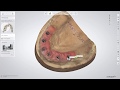 3shape dental system  full anatomy zirconia bridge on implants with gums