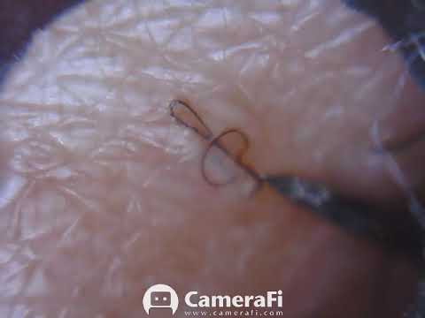 Satisfying ingrown hair removal #49 