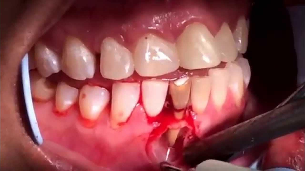 Endodontic surgery( Apicoectomy&Retrofilling& Bone Graft) YouTube