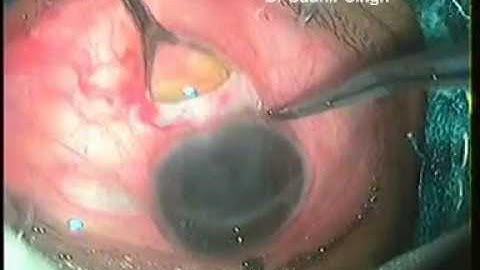 SICS In Typical Coloboma and Nuclear Cataract