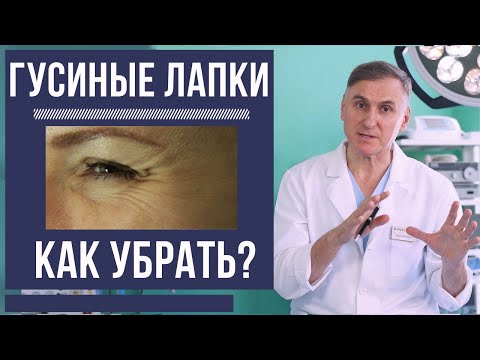 ❗️👍КАК УБРАТЬ ГУСИНЫЕ ЛАПКИ? ПРОЦЕДУРЫ И ПЛАСТИКА