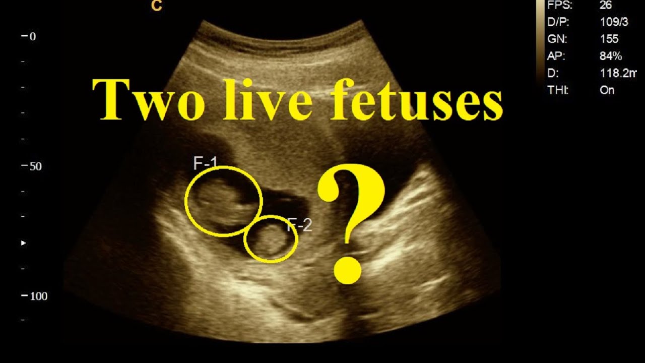 Twin Live Pregnancy Twins Ultrasound USG Full Format Amader twin-live-pregnancy-twins-ultrasound-usg-full-format-amader