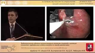 Эндоскопическое удаление множественных лейомиом пищевода(, 2015-01-16T11:48:41.000Z)