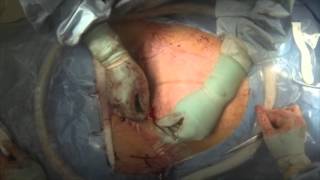 Closing The C-section Incision