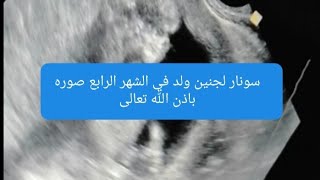 سونار للجنين في الشهر الرابع تعالي عرفيها بنفسك والعلامات الاكيده على الحمل في ولد باذن الله تعالى