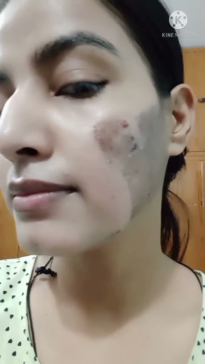 TCA Peel Remove 5th Day ||Chemical peel remove