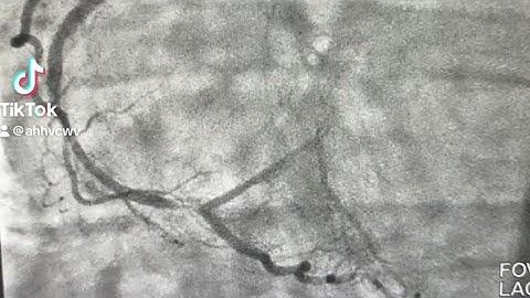 Bifurcation PCI -Provisional Technique, High risk PCI, step by step.