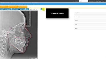 CephX | Editing Cephalometric Tracing