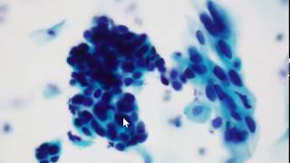 Cervical smear cytology  HSIL