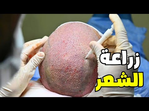 شاهد كيف تتم عملية زراعة الشعر |وتعرف علي الفرق ما بين التقنيات المستخدمة _Hair Transplant (FUE-DHI)