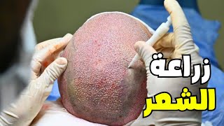 شاهد كيف تتم عملية زراعة الشعر |وتعرف علي الفرق ما بين التقنيات المستخدمة _Hair Transplant (FUE-DHI)