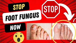 7 STEPS TO KEEP TOENAIL FUNGUS FROM RETURNING