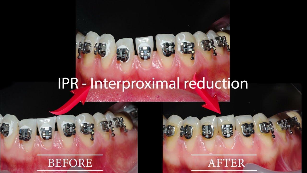 Learn more what is IPR ? Interproximal reduction (stripping) YouTube