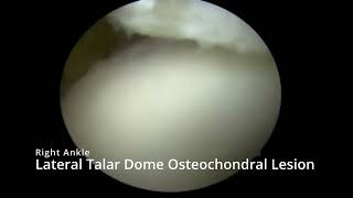 Autologous Collagen Induced Chondrogenesis for Osteochondral Lesions of the Talus