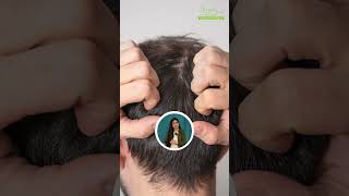 Scalp Psoriasis or Dandruff | Difference Between Scalp Psoriasis or Dandruff shorts psoriasis