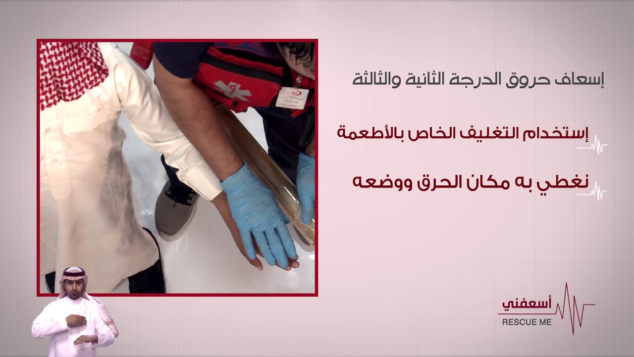 طريقة إسعاف الحروق