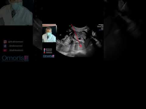 Сюрприз на первом УЗИ!! - Беременность 21 неделя #bebe #беременность #gestante