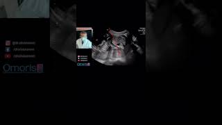 İlk ultrasonda sürpriz!! - Gebelik 21 hafta #bebek #hamilelik #gestante Resimi