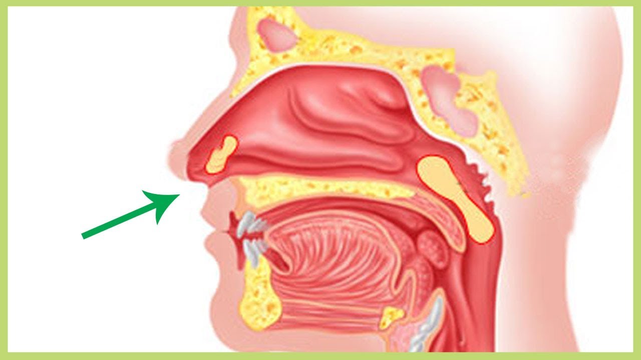 Adalah Akut Sinusitis Frontalis Adalah Akut Sinusitis Frontalis