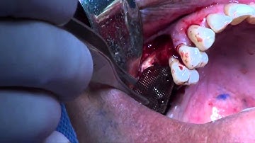 Vertical augmentation with GBR Ti Mesh Membrane