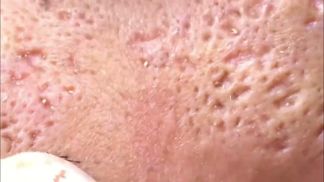 Blackhead Removal on Face Whiteheads, Pimples (Acne Scars) YouTube
