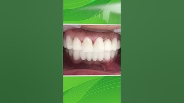 Thành quả Bọc Răng Sứ Thẩm Mỹ | Nha Khoa Khắc Ghi #shorts #youtubeshorts