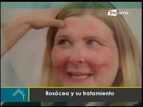 Rosácea y su tratamiento