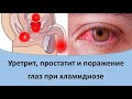 Уретрит, простатит и поражение глаз при хламидиозе