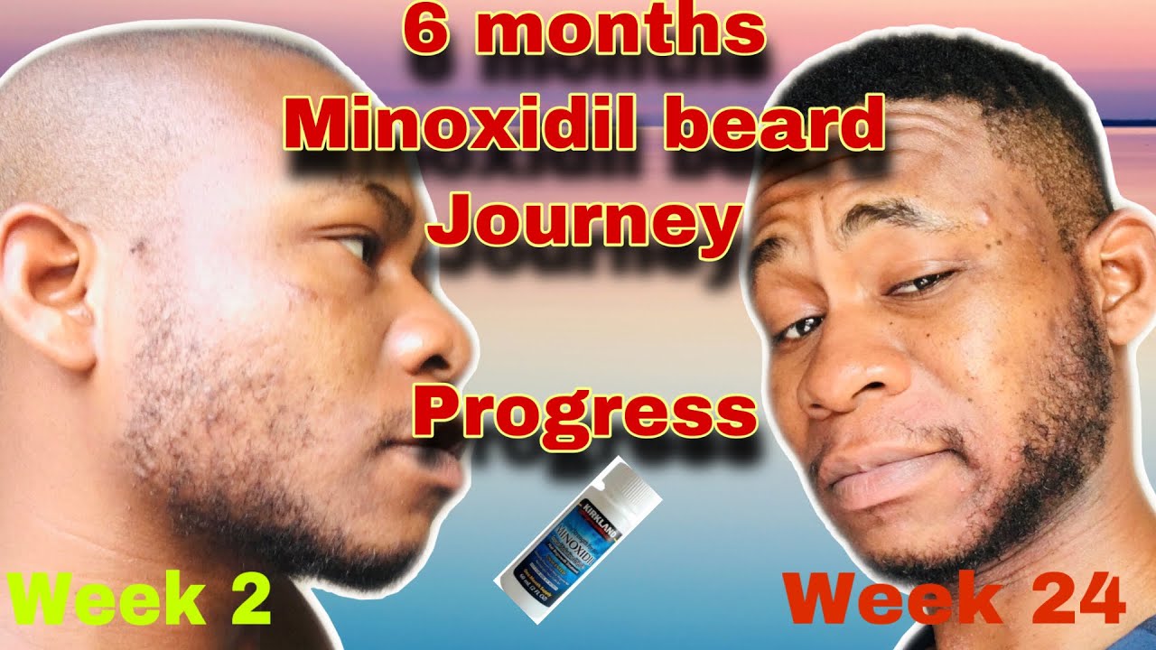 6 MONTHS PROGRESS ON MINOXIDIL BEARD JOURNEY - YouTube