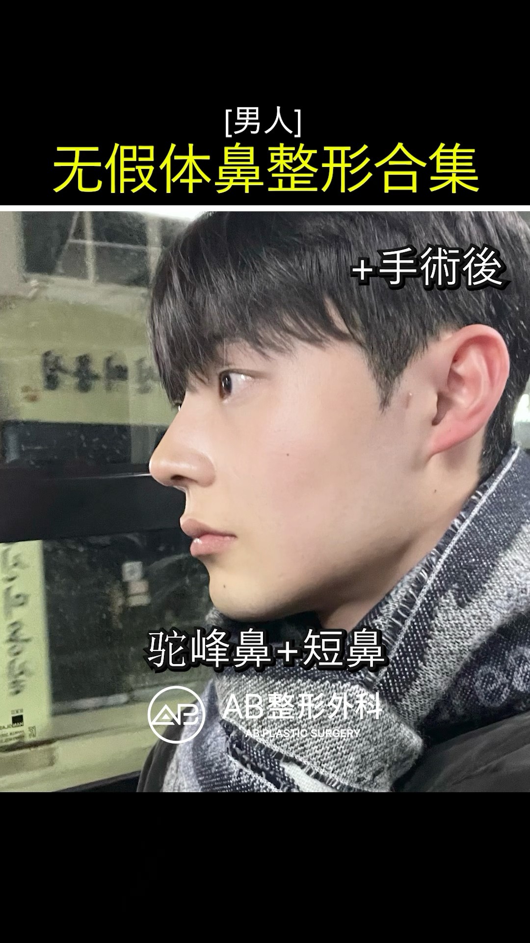 無矽膠隆鼻！男生也能自然變挺鼻 #shorts