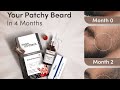 Minoxidil kese lagaye/ use kare| derma roller and minoxidil results beard #minoxidil #viralvideo