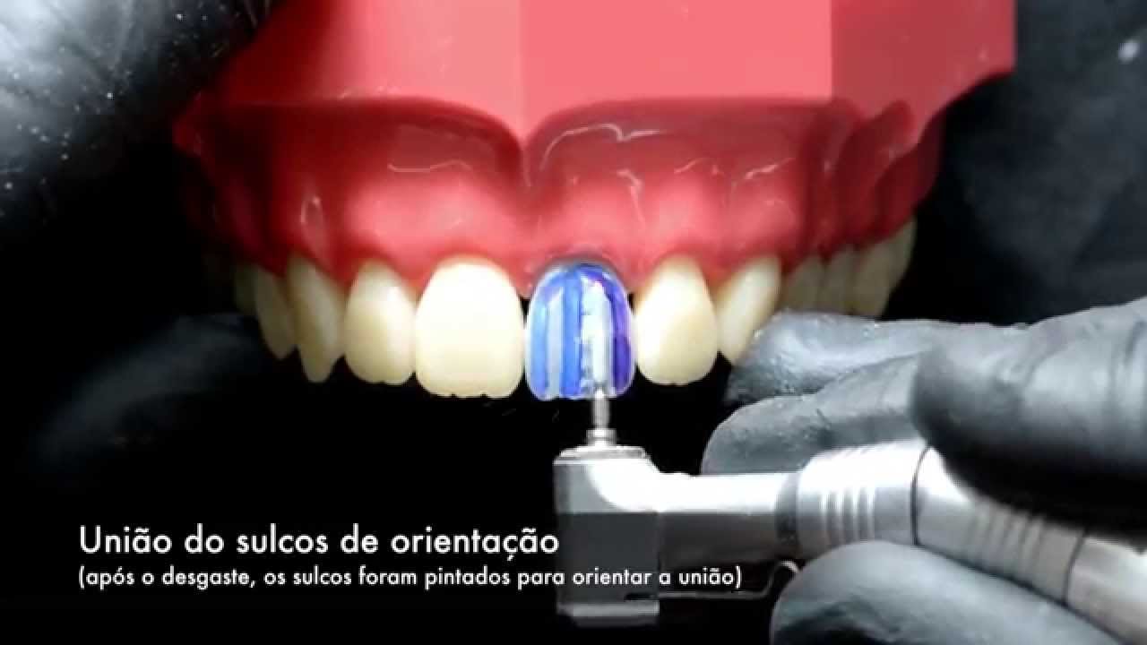 Video de como fazer garganta profunda Preparo para coroa metaloceramica