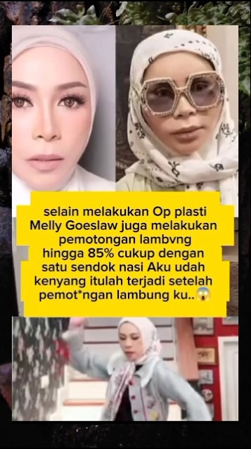 Selain melakukan op plastik Melly Goeslaw juga op pemotong4n l4mbvng