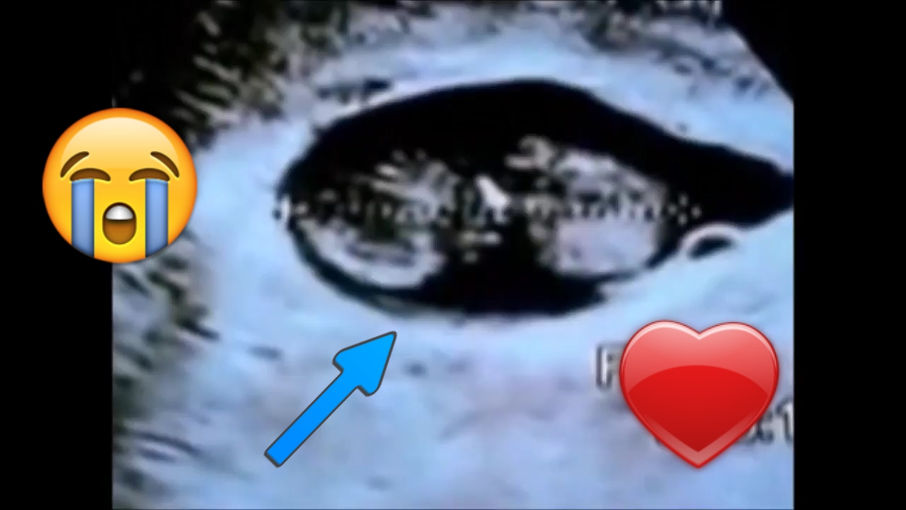 Abortion at week 8 of pregnancy Abortion at week 8 of pregnancy