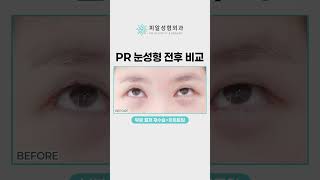[피알성형외과] 눈성형 전후 비교｜부분절개 눈재수술 하트트임