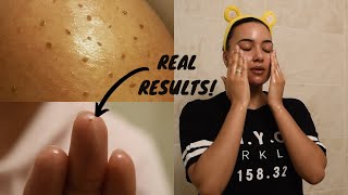 oil cleansing sebaceous filaments