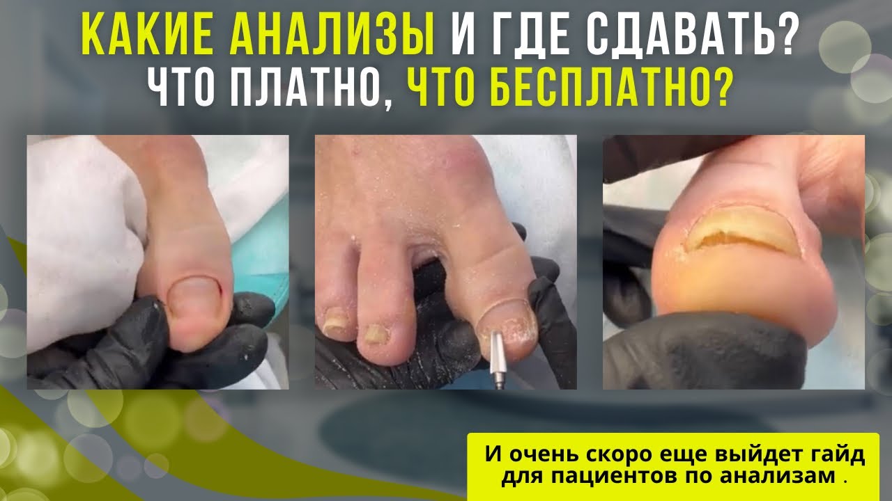 Какие анализы и где сдавать? / Что платно, что бесплатно? #гайд #анализ #ногти