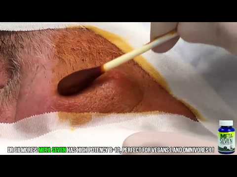 Huge Cyst Removal from Man&#;s Cheek!