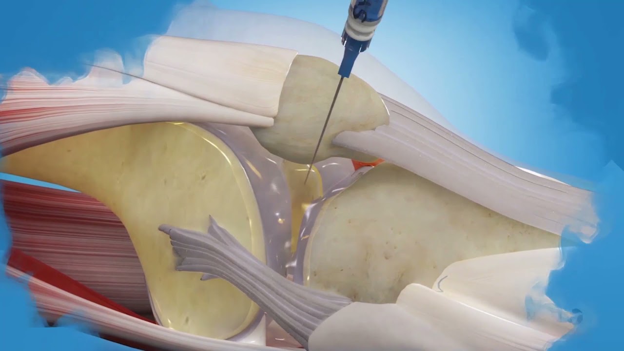 SYNVISC tecnica aplicacion 2020 1 - YouTube