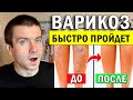 🔥Лечение ВАРИКОЗА вен на ногах БЕЗ ЛЕКАРСТВ  в домашних условиях ✅ Упражнения от Андрея Лопеса