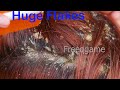 Dry Scalp Big Flakes | Dandruff removal with combing in my Sister's hair #35