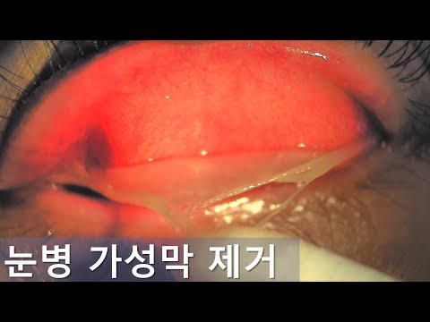 눈병 가성막 제거. Pseudomembrane peeling.