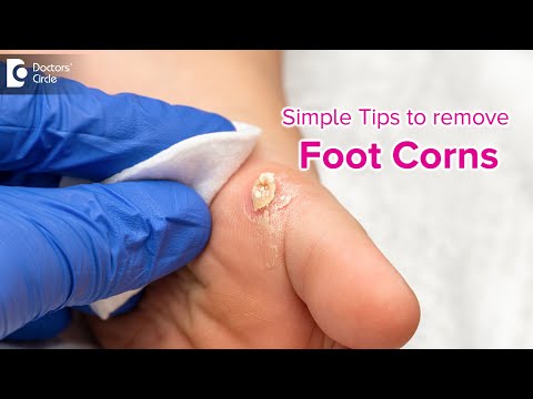 Simple tips to get rid of Foot Corn | Causes, Symptoms, Treatment-Dr. Rasya Dixit | Doctors' Circle