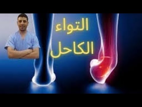 تمزق أربطة الكاحل التواء الكاحل جزع أربطة الكاحل الكاحل التواء الكاحل