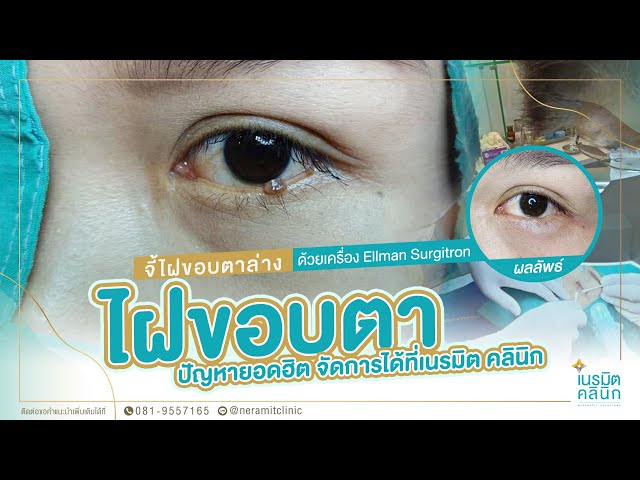 รีวิวตัดไฝ ขี้แมลงวัน EP.145/จี้ไฝขอบตาล่าง ปัญหายอดฮิตแก้ไขได้ที่เนรมิต @หมอปุ๊ NeramitClinic
