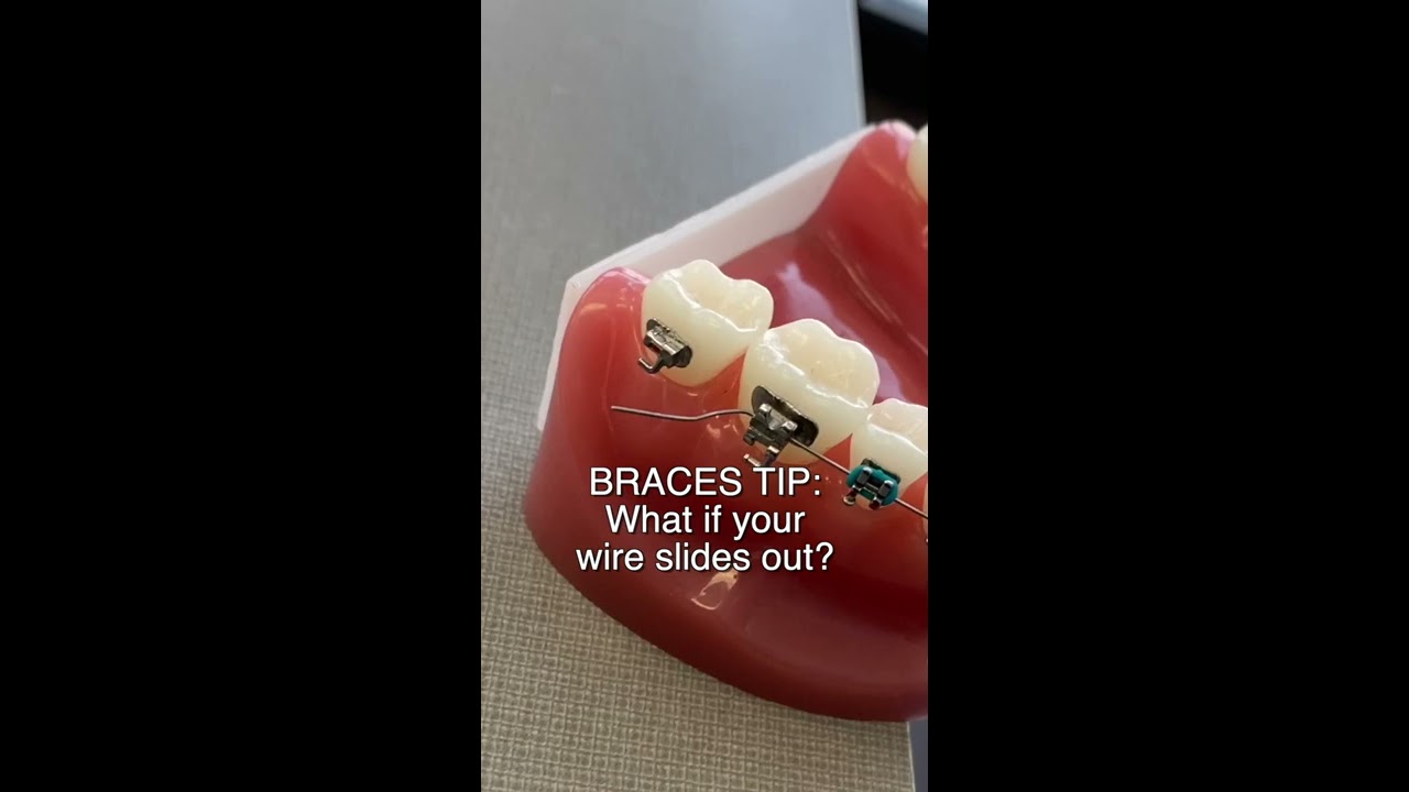 Braces Wire Poking Cheeks Or Gums Here S What To Do Shorts